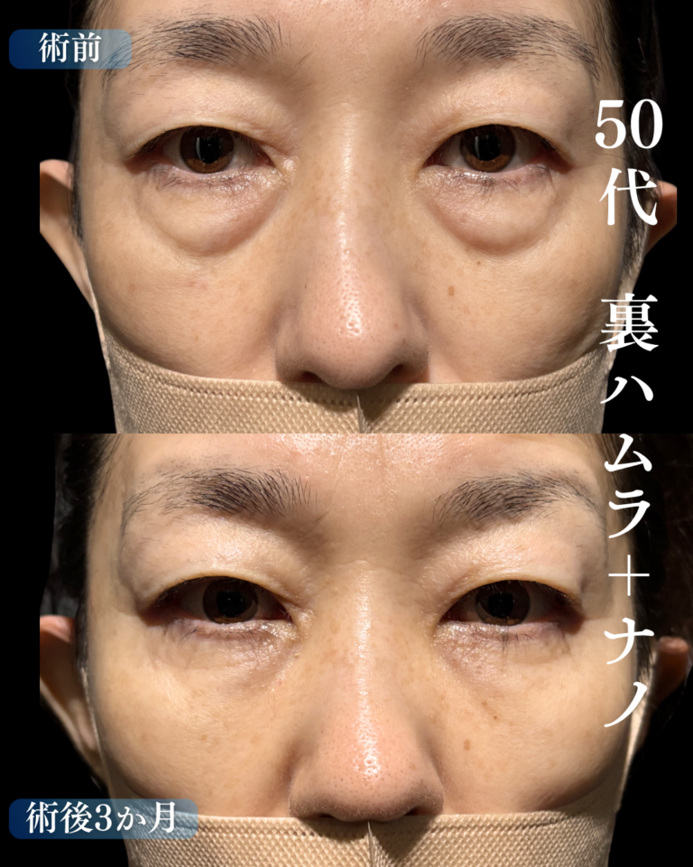 50代女性　裏ハムラ+脂肪注入